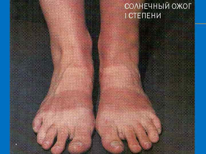 СОЛНЕЧНЫЙ ОЖОГ I СТЕПЕНИ 