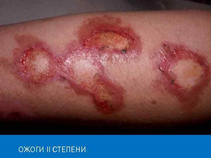 ОЖОГИ II СТЕПЕНИ 