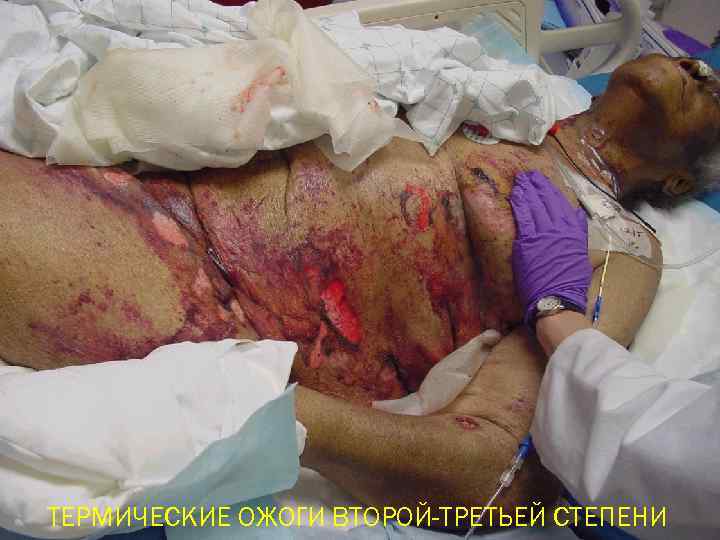 ТЕРМИЧЕСКИЕ ОЖОГИ ВТОРОЙ-ТРЕТЬЕЙ СТЕПЕНИ 