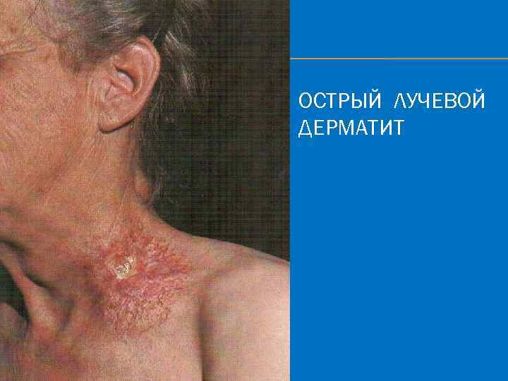 ОСТРЫЙ ЛУЧЕВОЙ ДЕРМАТИТ 