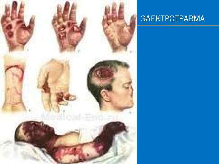 э ЭЛЕКТРОТРАВМА 