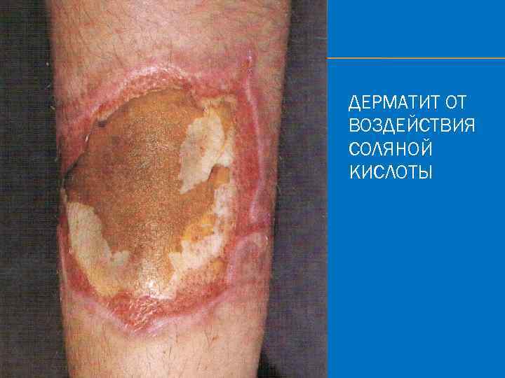 ДЕРМАТИТ ОТ ВОЗДЕЙСТВИЯ СОЛЯНОЙ КИСЛОТЫ 