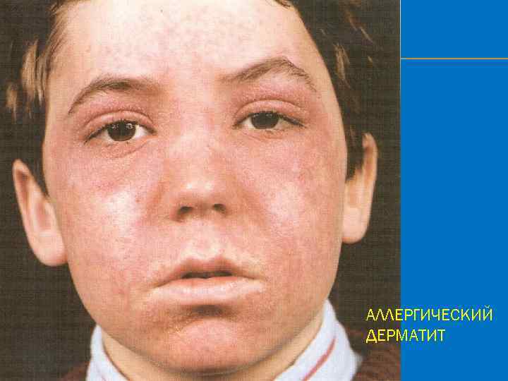 АЛЛЕРГИЧЕСКИЙ ДЕРМАТИТ 