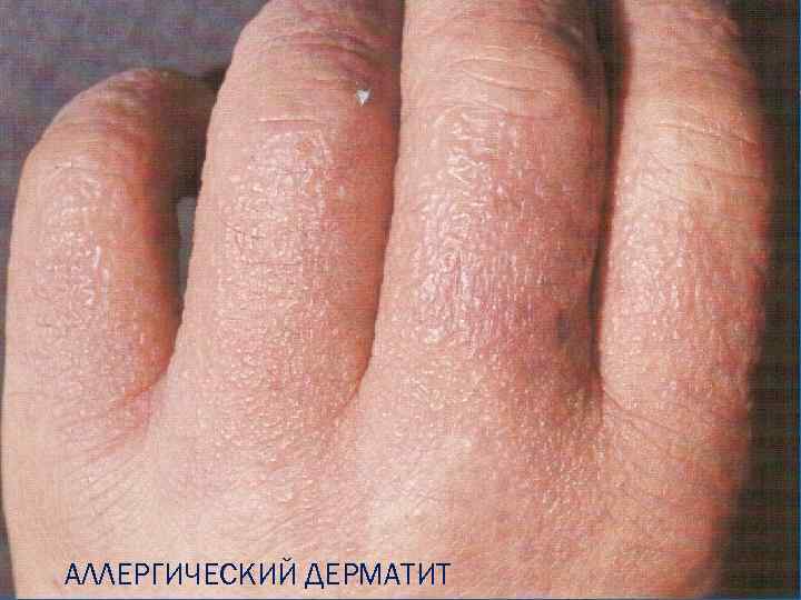 АЛЛЕРГИЧЕСКИЙ ДЕРМАТИТ 