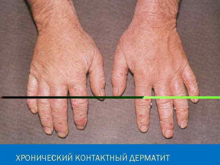 ХРОНИЧЕСКИЙ КОНТАКТНЫЙ ДЕРМАТИТ 