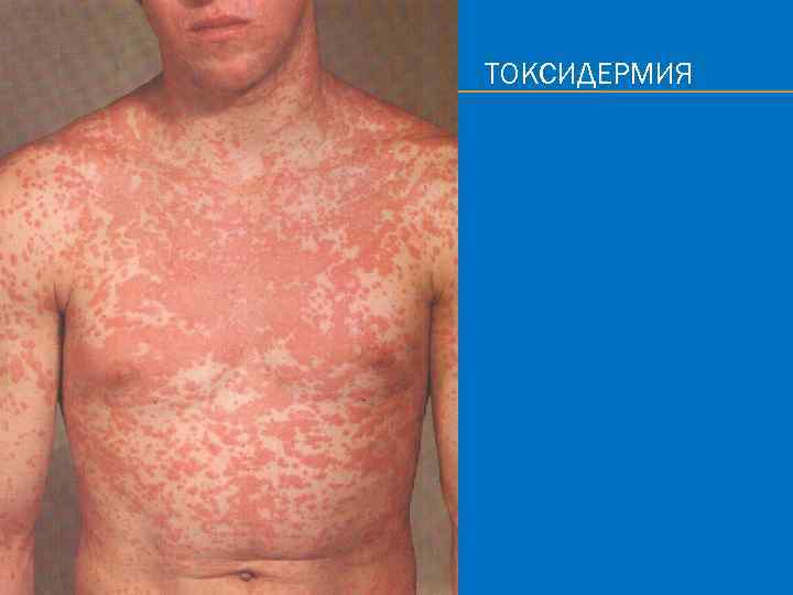 ТОКСИДЕРМИЯ 