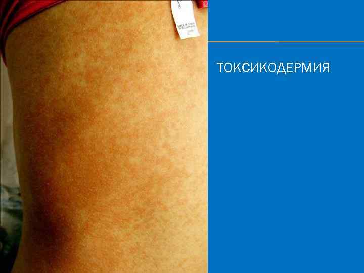 ТОКСИКОДЕРМИЯ 