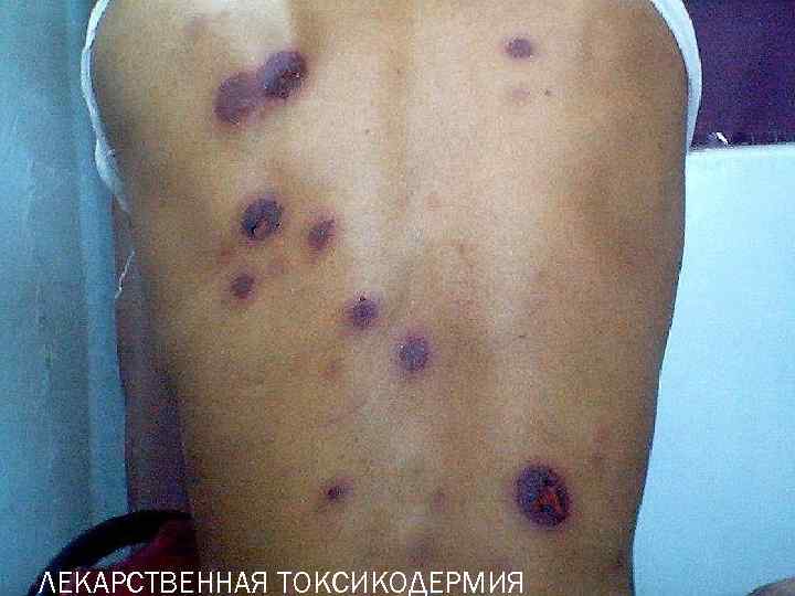 ЛЕКАРСТВЕННАЯ ТОКСИКОДЕРМИЯ 