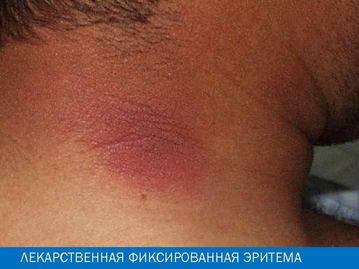 ЛЕКАРСТВЕННАЯ ФИКСИРОВАННАЯ ЭРИТЕМА 