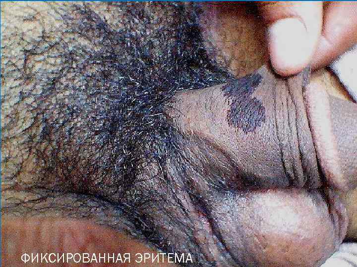 ФИКСИРОВАННАЯ ЭРИТЕМА 