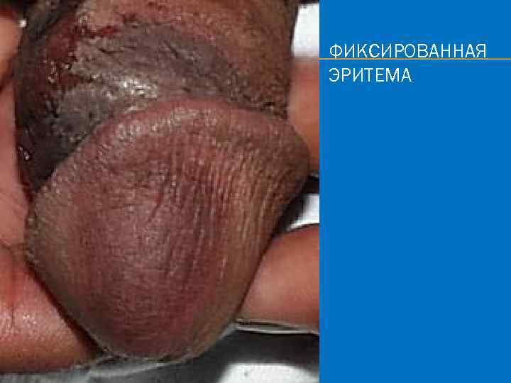 ФИКСИРОВАННАЯ ЭРИТЕМА 