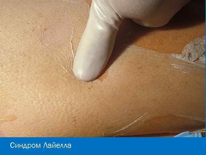 Синдром Лайелла 