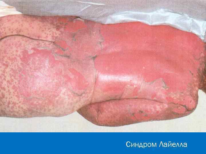 Синдром Лайелла 