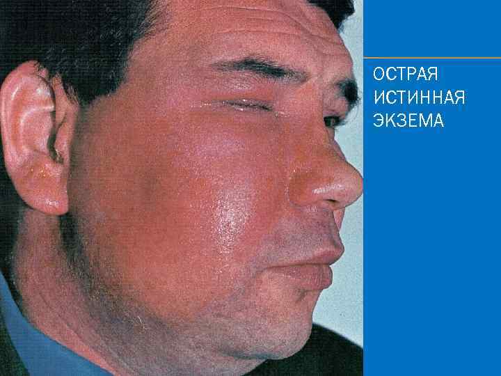 ОСТРАЯ ИСТИННАЯ ЭКЗЕМА 