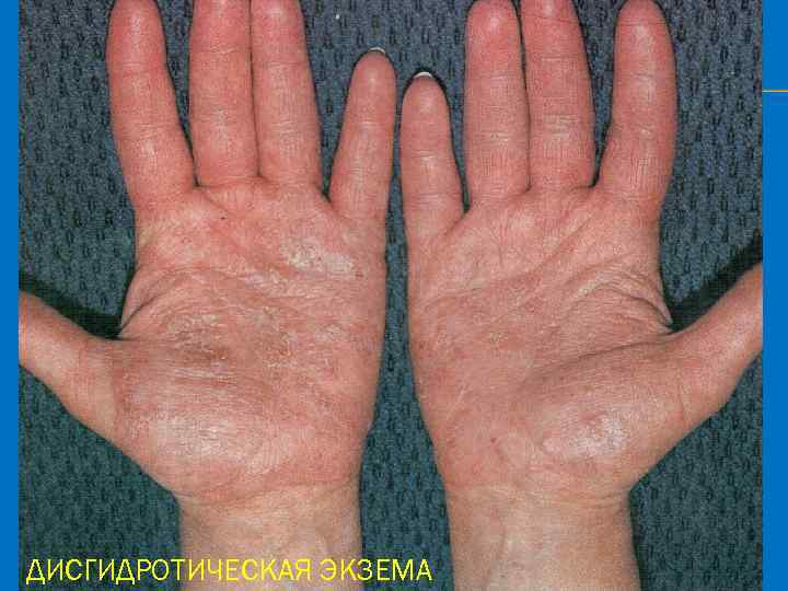 ДИСГИДРОТИЧЕСКАЯ ЭКЗЕМА 