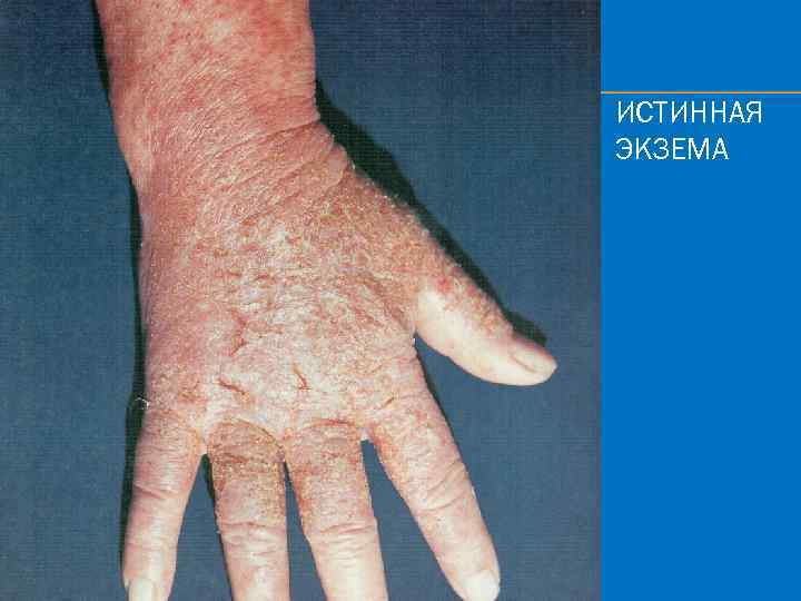 ИСТИННАЯ ЭКЗЕМА 