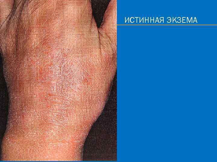 ИСТИННАЯ ЭКЗЕМА 