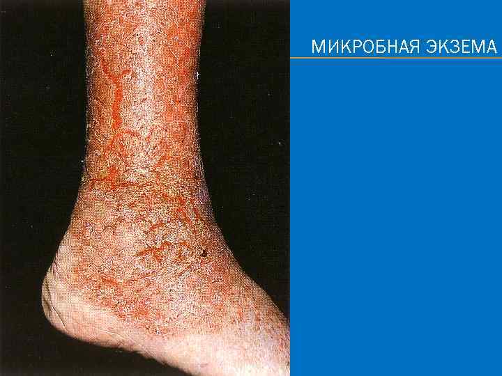 МИКРОБНАЯ ЭКЗЕМА 