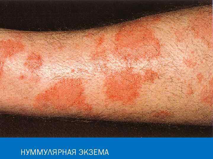 НУММУЛЯРНАЯ ЭКЗЕМА 