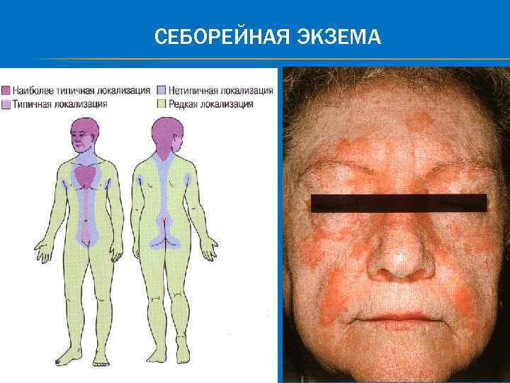 СЕБОРЕЙНАЯ ЭКЗЕМА 