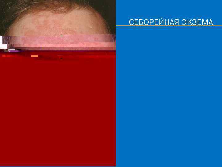 СЕБОРЕЙНАЯ ЭКЗЕМА 