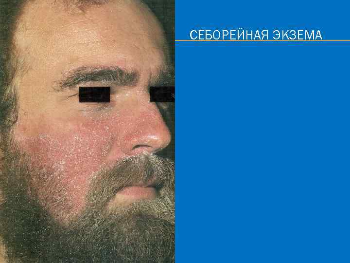 СЕБОРЕЙНАЯ ЭКЗЕМА 