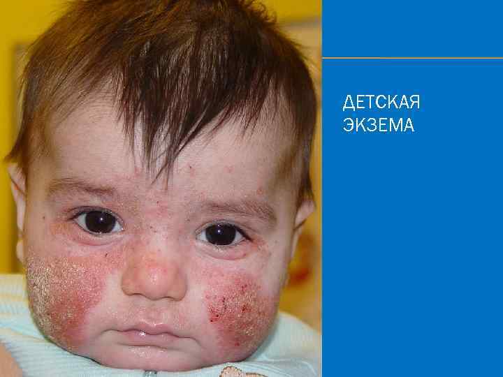 ДЕТСКАЯ ЭКЗЕМА 