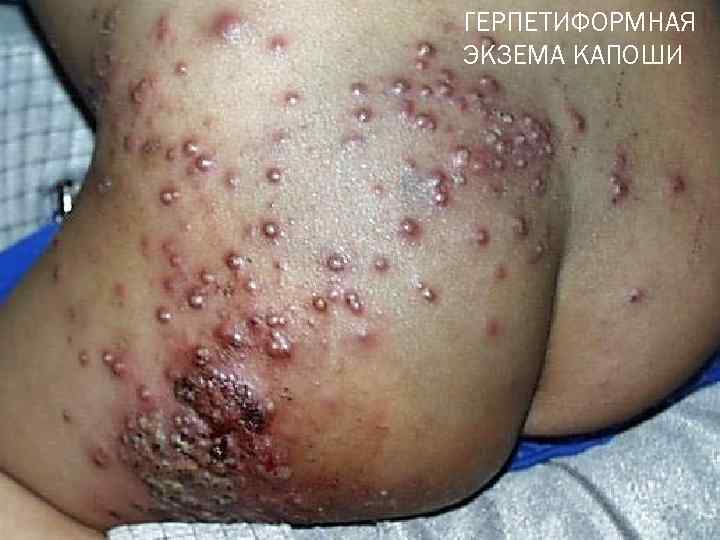 ГЕРПЕТИФОРМНАЯ ЭКЗЕМА КАПОШИ 