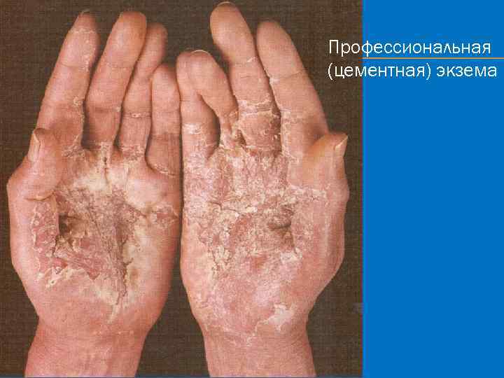 Профессиональная (цементная) экзема 