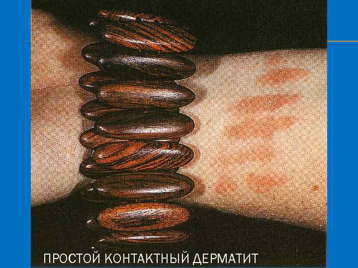 ПРОСТОЙ КОНТАКТНЫЙ ДЕРМАТИТ 