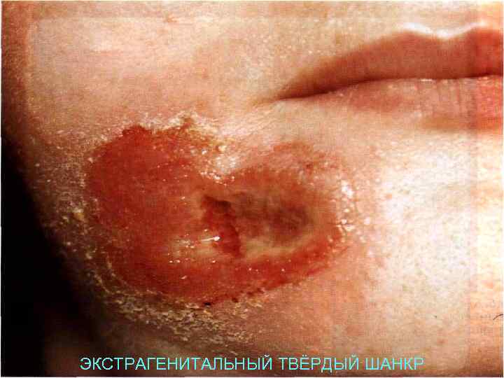 ЭКСТРАГЕНИТАЛЬНЫЙ ТВЁРДЫЙ ШАНКР 