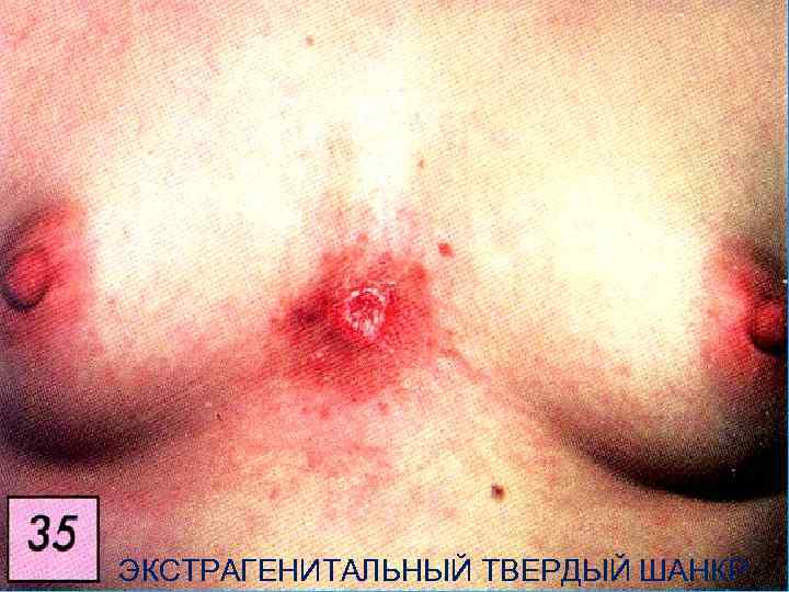 ЭКСТРАГЕНИТАЛЬНЫЙ ТВЕРДЫЙ ШАНКР 