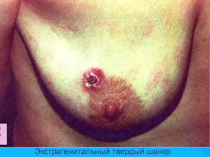 Экстрагенитальный твердый шанкр 