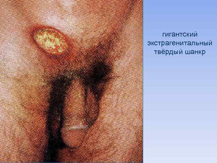 гигантский экстрагенитальный твёрдый шанкр 