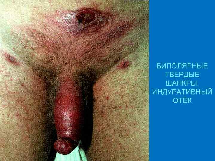 БИПОЛЯРНЫЕ ТВЕРДЫЕ ШАНКРЫ, ИНДУРАТИВНЫЙ ОТЁК 