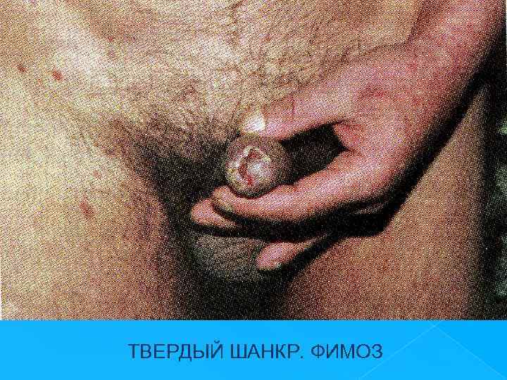 ТВЕРДЫЙ ШАНКР. ФИМОЗ 
