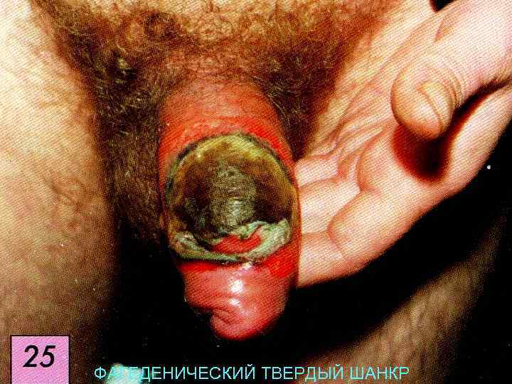 ФАГЕДЕНИЧЕСКИЙ ТВЕРДЫЙ ШАНКР 