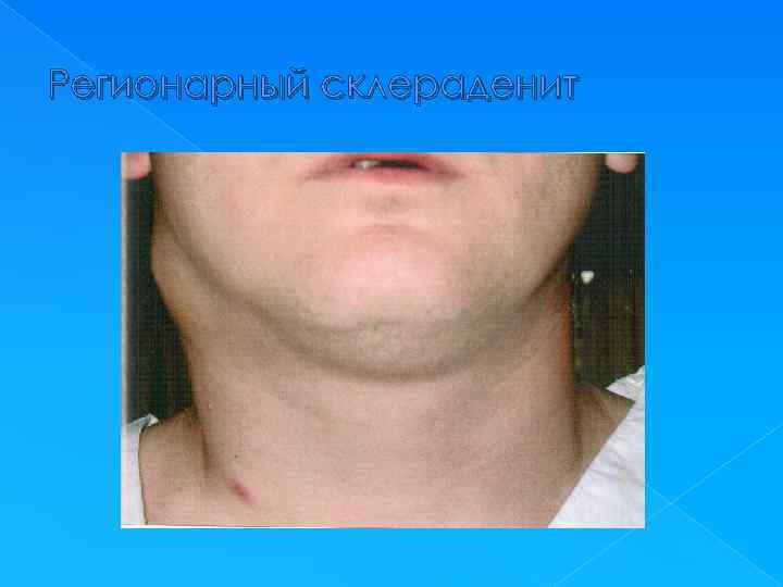 Регионарный склераденит 
