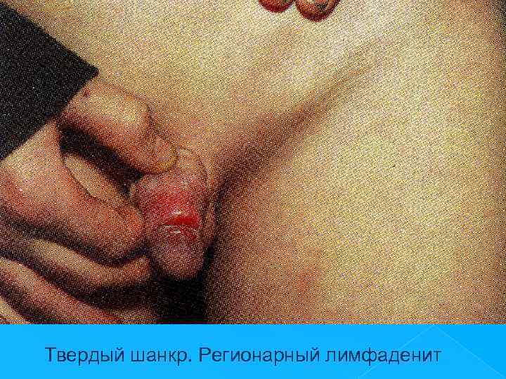 Твердый шанкр. Регионарный лимфаденит 