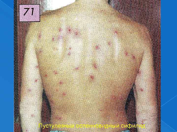 Пустулезный оспенновидный сифилид 