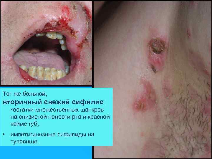 Тот же больной, вторичный свежий сифилис: • остатки множественных шанкров на слизистой полости рта