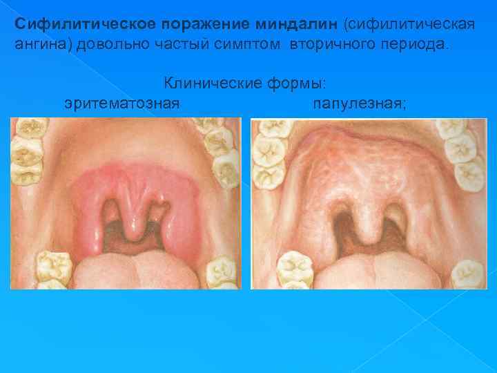 Сифилитическое поражение миндалин (сифилитическая ангина) довольно частый симптом вторичного периода. Клинические формы: эритематозная папулезная;