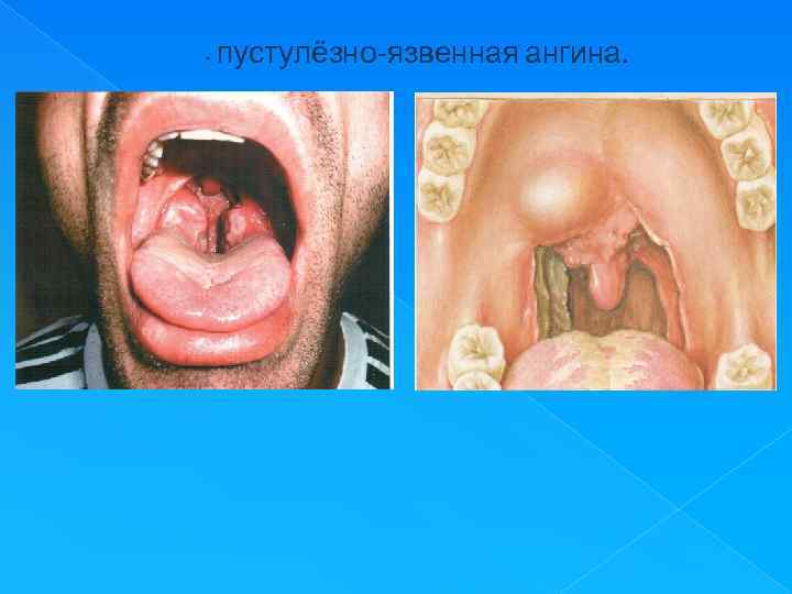  пустулёзно язвенная ангина. 