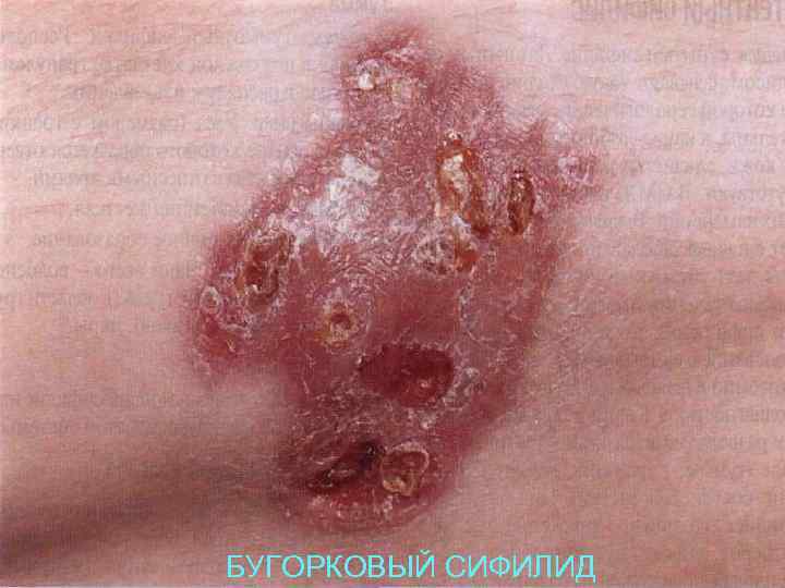БУГОРКОВЫЙ СИФИЛИД 