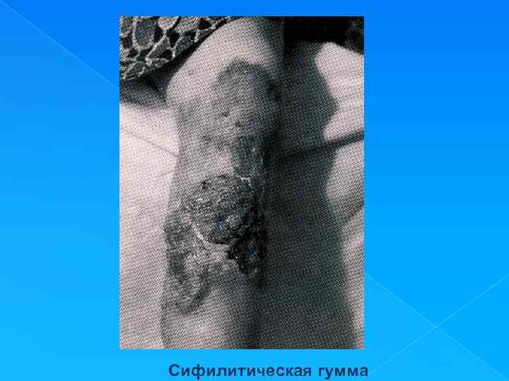 Сифилитическая гумма 