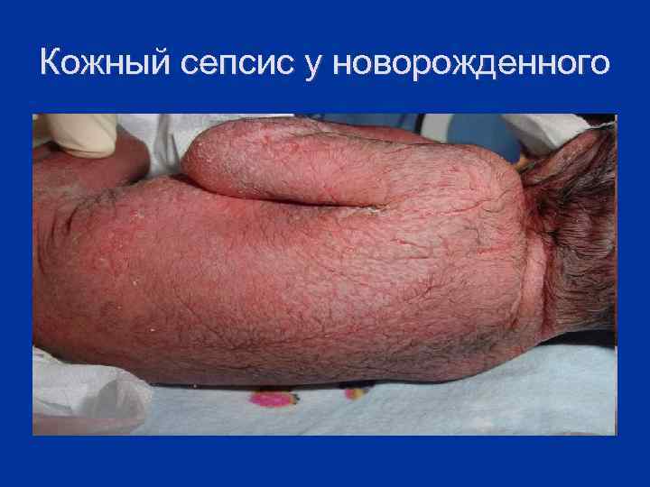 Кожный сепсис у новорожденного 