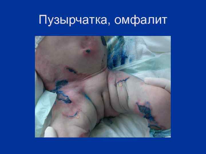 Пузырчатка, омфалит 