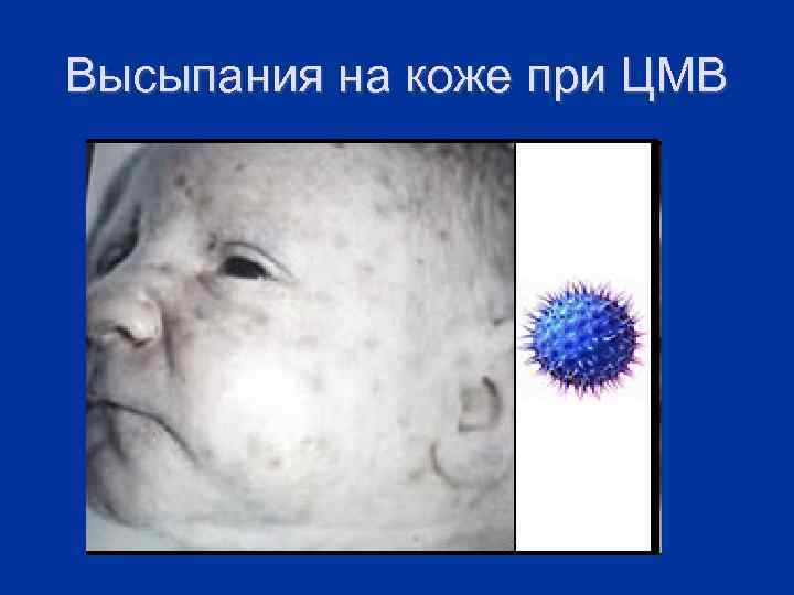 Высыпания на коже при ЦМВ 