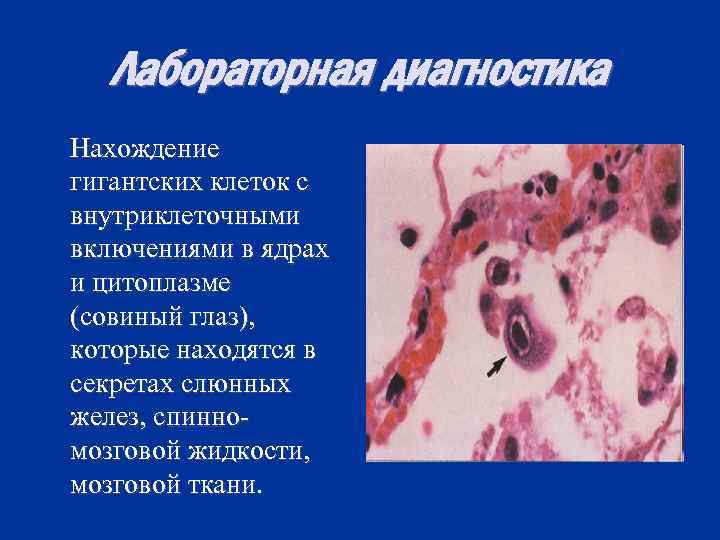 Лабораторная диагностика Нахождение гигантских клеток с внутриклеточными включениями в ядрах и цитоплазме (совиный глаз),