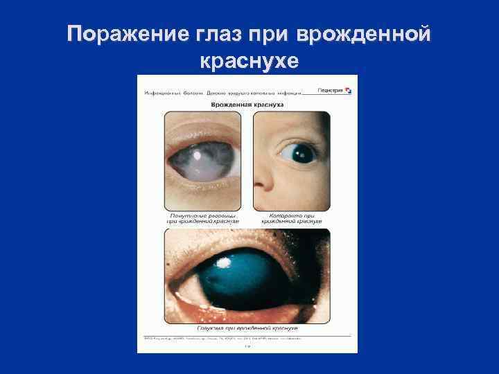 Поражение глаз при врожденной краснухе 